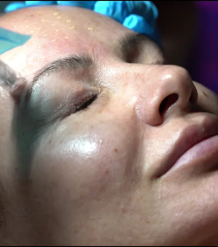 A real PRP skin treatment being performed at LESIQUE SPA.