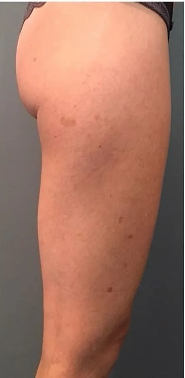 The same client treatment area after Body Reset care at LESIQUE SPA.