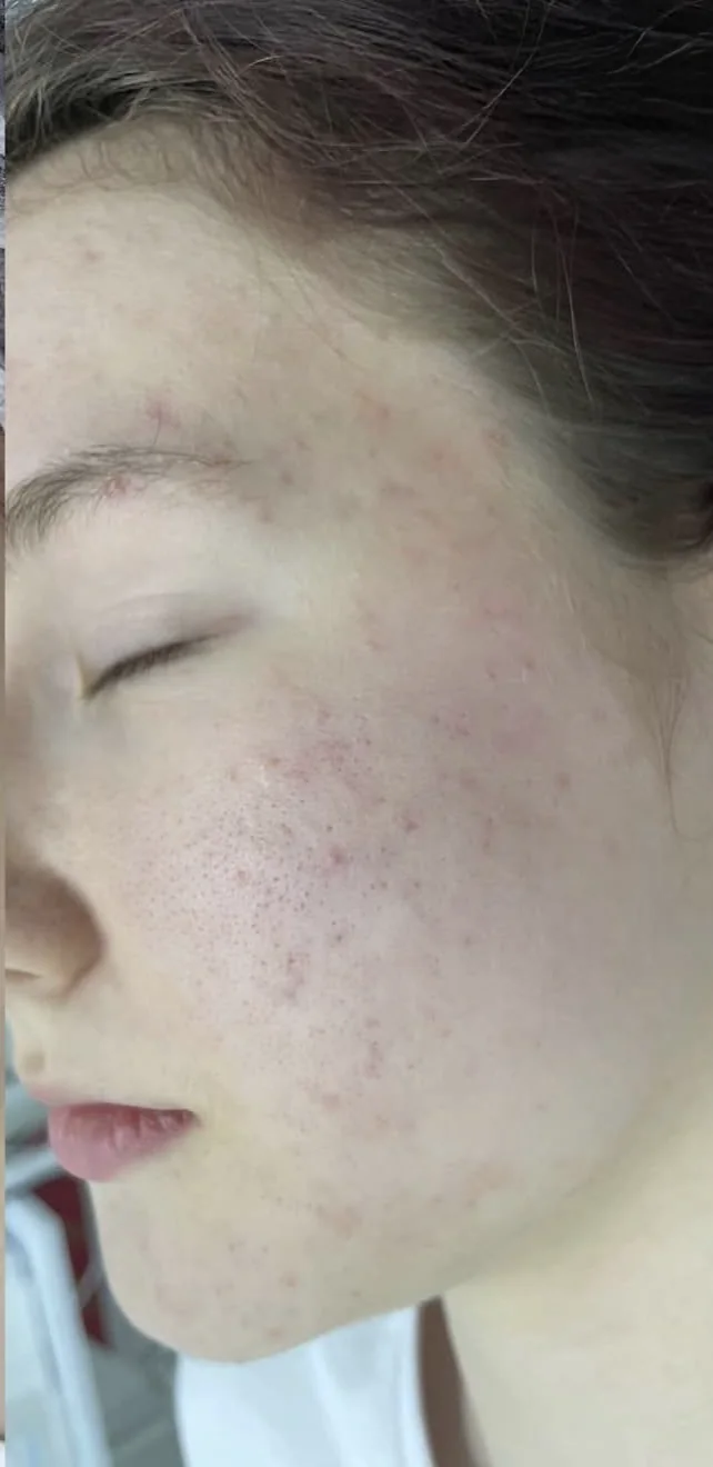 The same client’s skin after a Custom Facial at LESIQUE SPA.