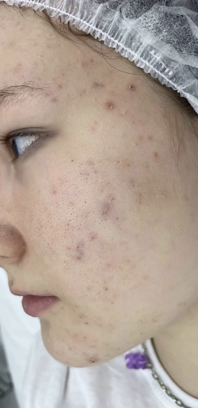 Client skin before a Custom Facial at LESIQUE SPA.