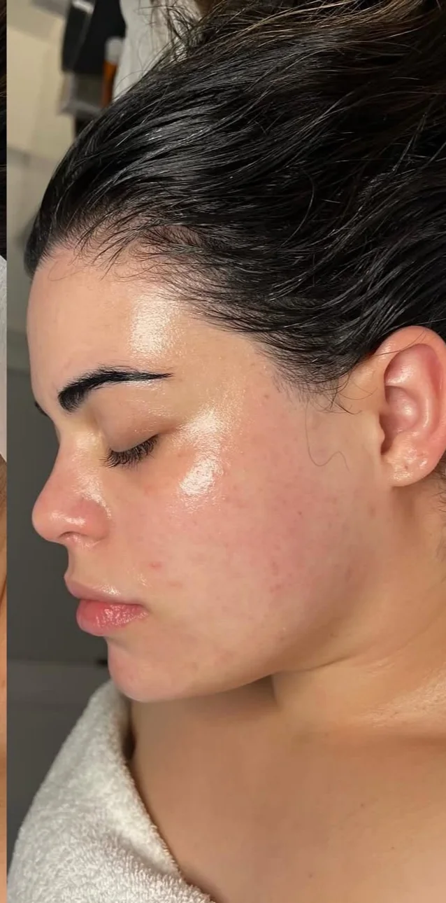 The same client after a Facial Sculpt treatment at LESIQUE SPA.