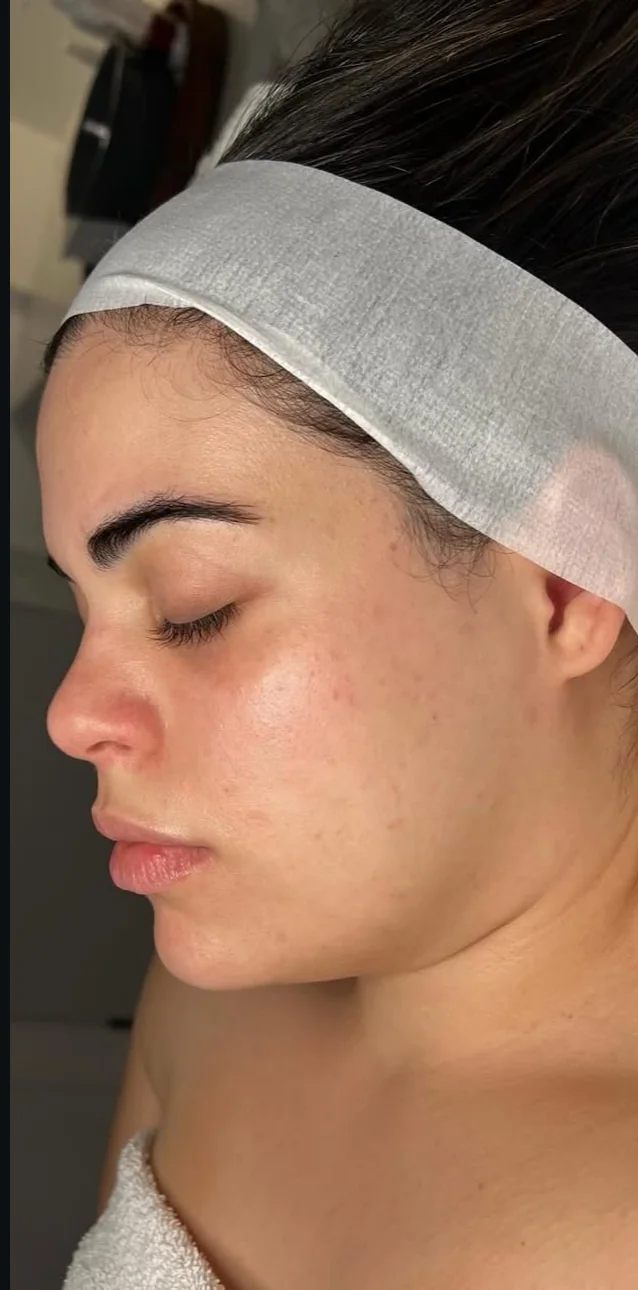 Client before a Facial Sculpt treatment at LESIQUE SPA.
