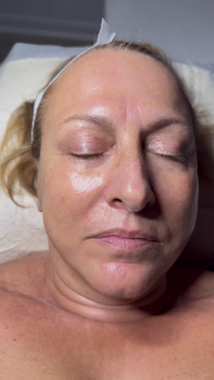 The same client’s post-treatment skin appearance on the microneedling treatment date; not a final result.