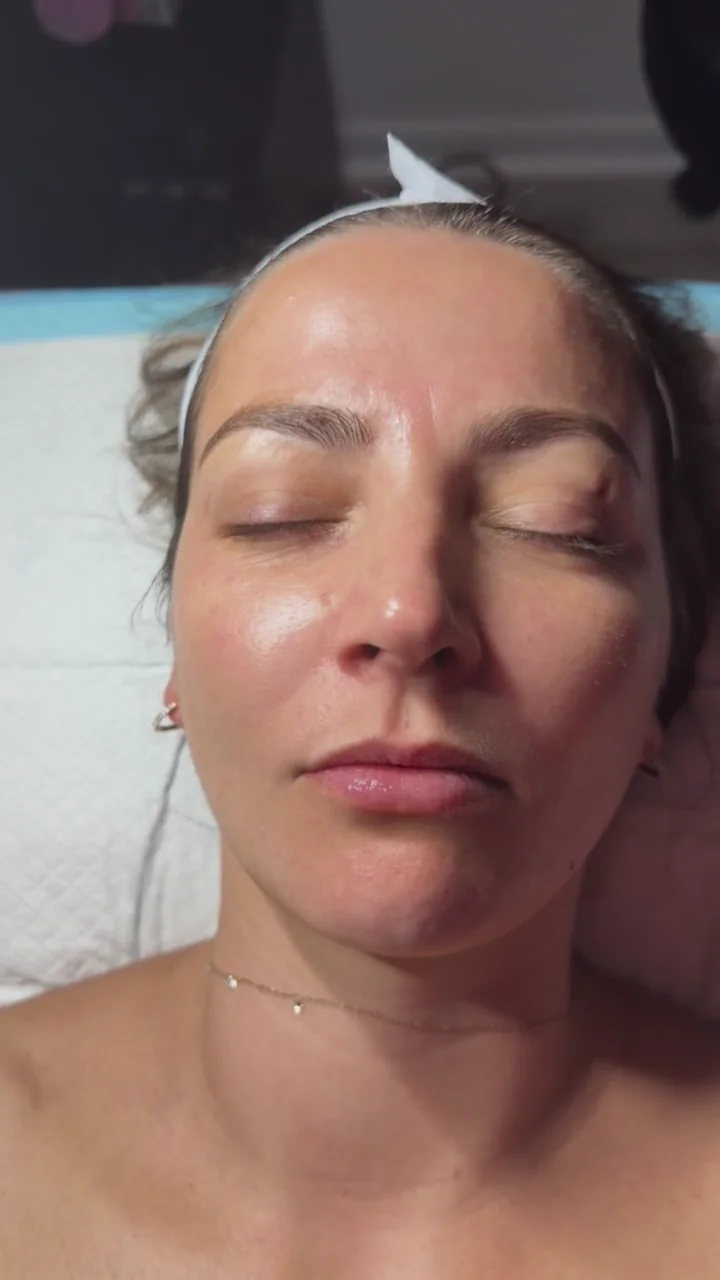The same client’s post-treatment skin appearance on the PRP treatment date; not a final result.