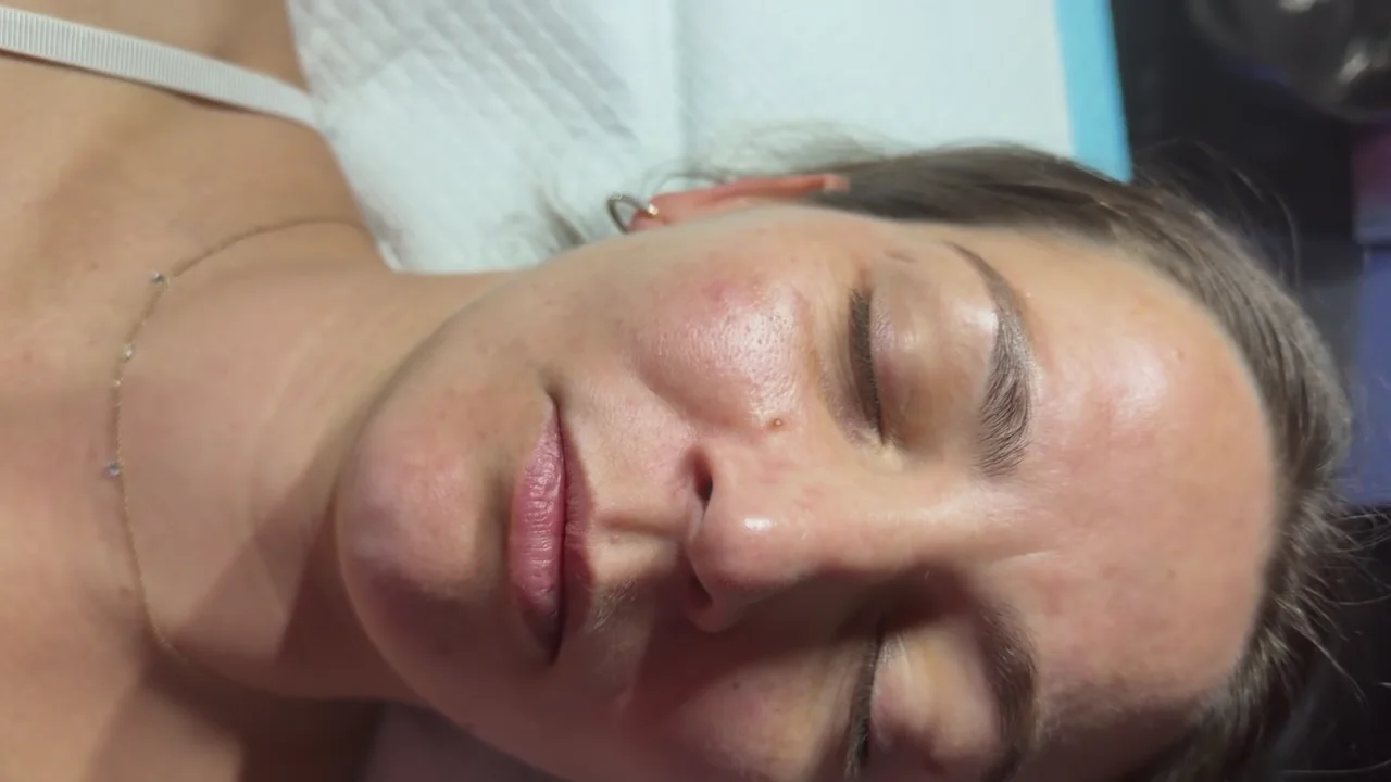 Client skin photographed before PRP on the treatment date.